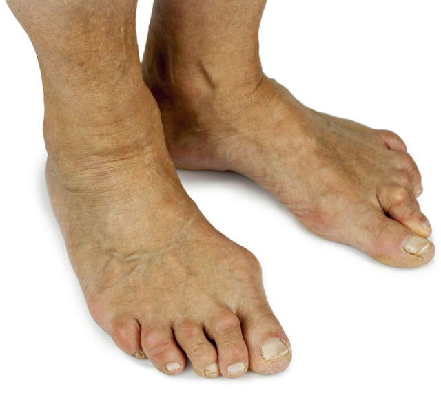 A pair of feet with bunions an hammer toes