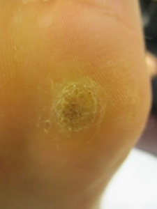 Office Surgical Procedures: Plantar Warts/ Verrucae - ACT Podiatry