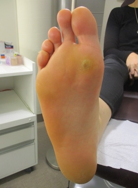 Office Surgical Procedures Plantar Warts Verrucae Act Podiatry 2709