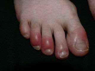 red chilblains on toes of white mans foot